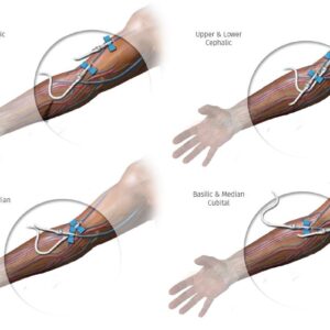 Endovascular AV Fistula Creation and Use – Group Access Course